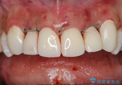 歯ぐきの状態を改善した上顎前歯セラミック治療の治療中