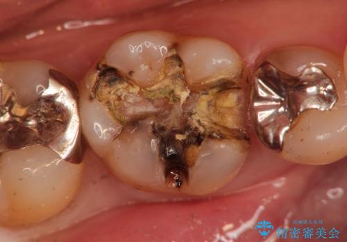 銀歯の下に再発した虫歯の審美的セラミック治療の治療中