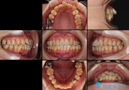 30代女性　上の前歯の出っ歯　前歯のガタガタ　メタルブラケットの治療前