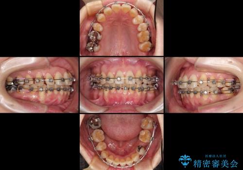 30代女性　上の前歯の出っ歯　前歯のガタガタ　メタルブラケットの治療中