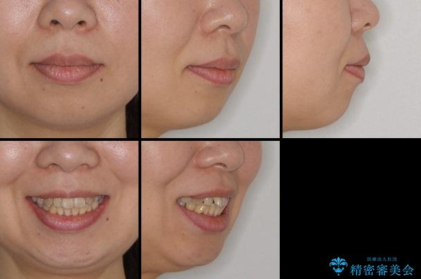 30代女性　上の前歯の出っ歯　前歯のガタガタ　メタルブラケットの治療前（顔貌）