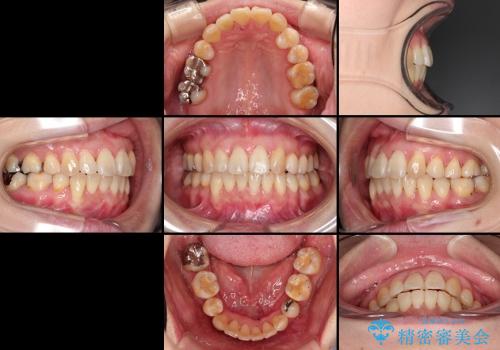 30代女性　上の前歯の出っ歯　前歯のガタガタ　メタルブラケットの治療後