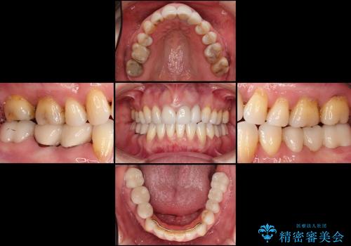セラミック治療(銀歯のブリッジ治療と腫れた歯肉改善)の治療後