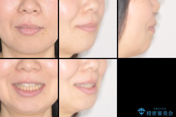30代女性　上の前歯の出っ歯　前歯のガタガタ　メタルブラケットの治療後（顔貌）