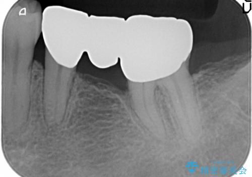 セラミック治療(銀歯のブリッジ治療と腫れた歯肉改善)の治療前