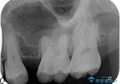 40代男性　虫歯 歯の神経を残したい(歯髄温存療法)の治療前