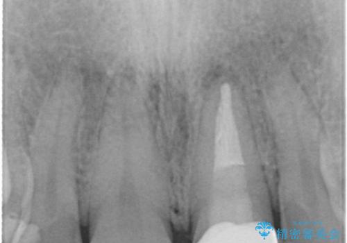 前歯の1歯のセラミッククラウン(スタンダードタイプ)の治療後