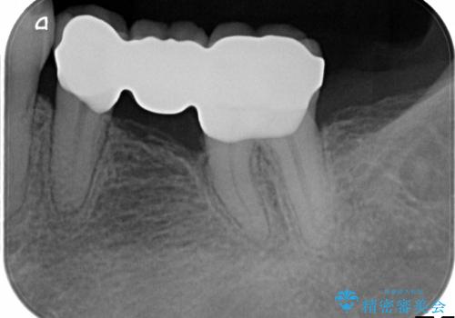 セラミック治療(銀歯のブリッジ治療と腫れた歯肉改善)の治療後