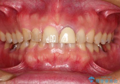 前歯の1歯のセラミッククラウン(スタンダードタイプ)の治療前