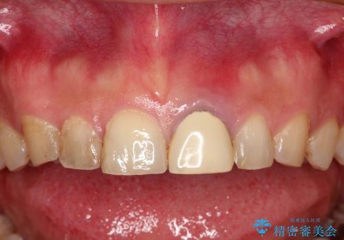 前歯の1歯のセラミッククラウン(スタンダードタイプ)の症例 治療前
