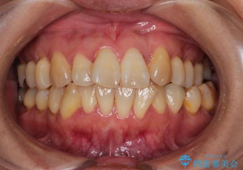 30代女性　上の前歯の出っ歯　前歯のガタガタ　メタルブラケット