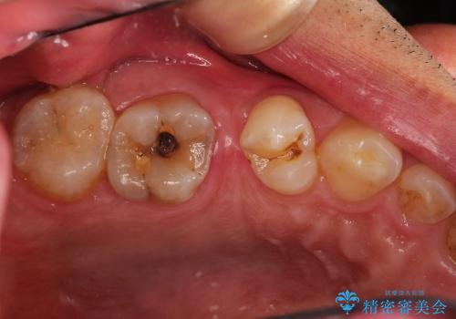 40代男性　虫歯 歯の神経を残したい(歯髄温存療法)の症例 治療前