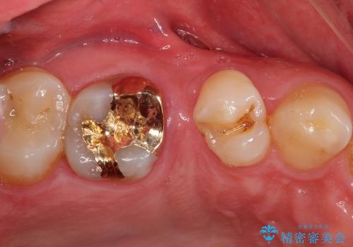 40代男性　虫歯 歯の神経を残したい(歯髄温存療法)の症例 治療後