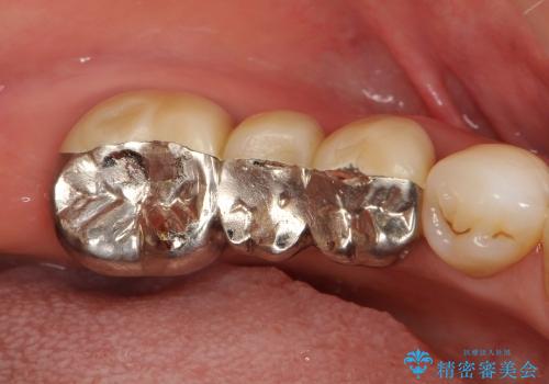セラミック治療(銀歯のブリッジ治療と腫れた歯肉改善)の治療前