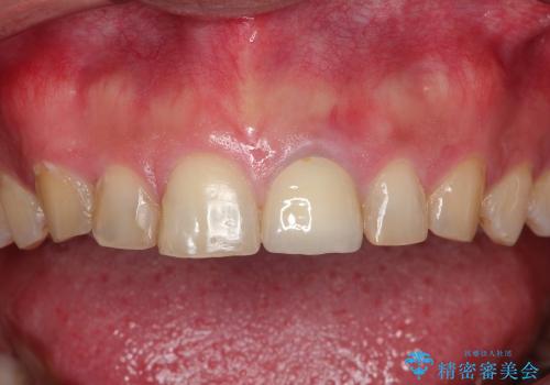 前歯の1歯のセラミッククラウン(スタンダードタイプ)の症例 治療後