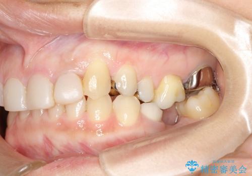咬合平面の乱れを改善(全顎矯正歯科治療)の治療前