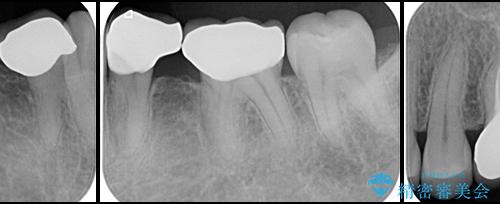 奥歯の銀歯をセラミックに(矯正歯科治療で閉じきれなかったスペース)の治療後