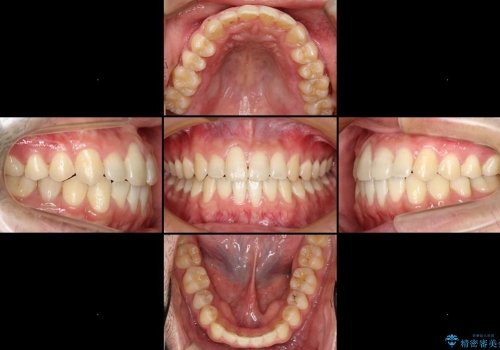 20代男性　前歯の歯並びをなおしたいの治療後