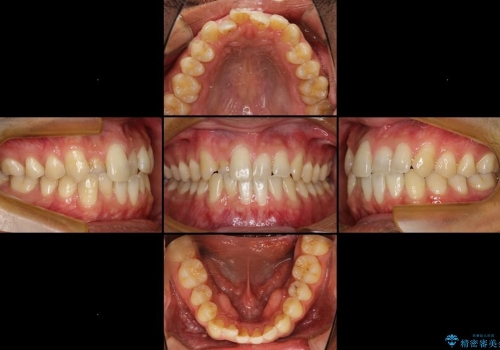 20代男性　前歯の歯並びをなおしたいの治療前
