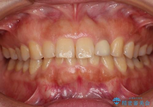 前歯1本の審美歯科治療の治療前