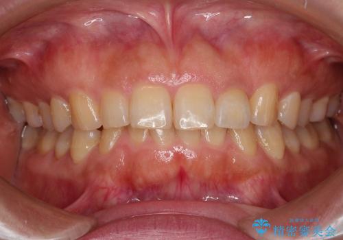 前歯1本の審美歯科治療の症例 治療後