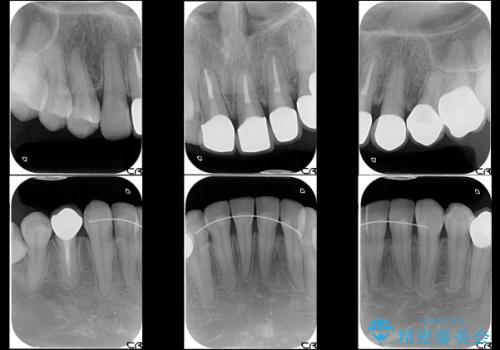 総合歯科診療(矯正歯科治療と審美補綴治療)の治療後