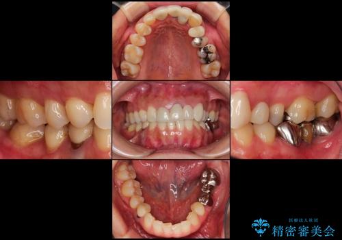 総合歯科診療(矯正歯科治療と審美補綴治療)の治療前