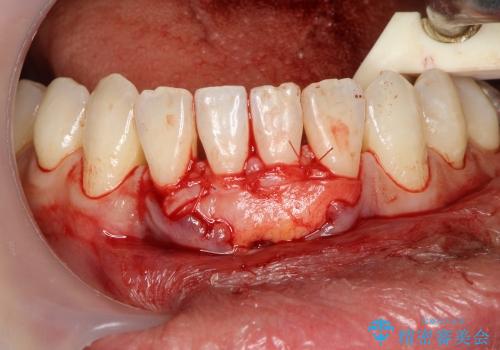 矯正治療後に下がってしまった歯ぐきの再生治療の治療中