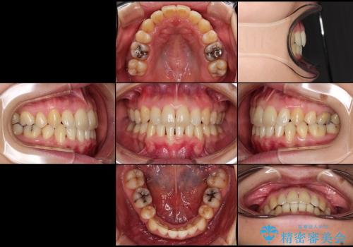 30代女性 ハーフリンガル 1年半の抜歯矯正の治療後
