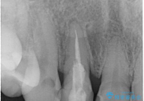 前歯の1歯のセラミッククラウン(オーダーメイドタイプ)の治療前
