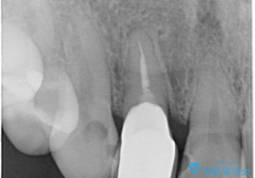 前歯の1歯のセラミッククラウン(オーダーメイドタイプ)の治療後