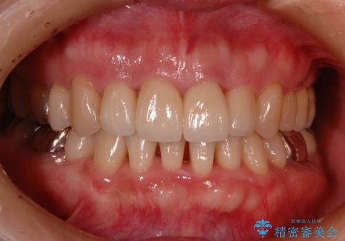 30代女性 前歯の被せものの再修復の治療後