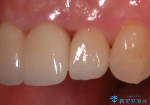 30代女性 前歯の被せものの再修復の治療後
