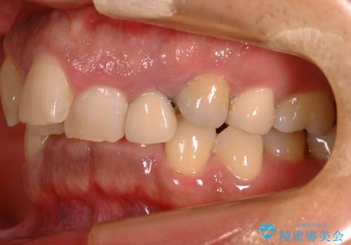 全顎矯正および前歯部ブリッジによる審美治療の治療前