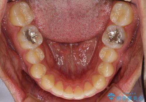奥歯のセラミック治療(審美)の治療前