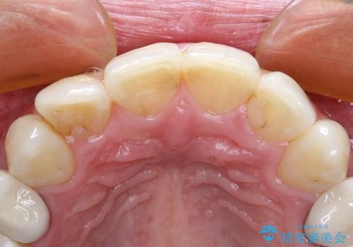 20代女性 歯のねじれ→被せものによる審美修復の治療前