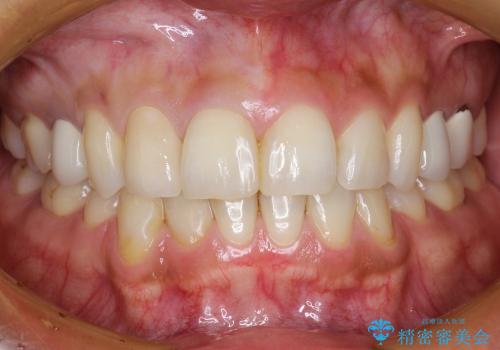 20代女性 歯のねじれ→被せものによる審美修復の症例 治療後