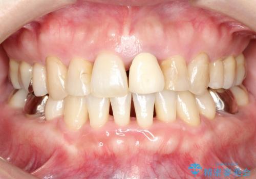 30代女性 前歯の被せものの再修復の治療前