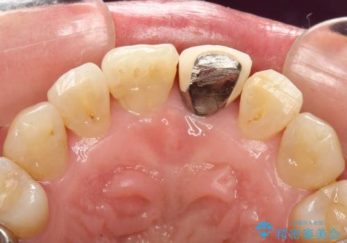 30代女性 前歯の被せものの再修復の治療前