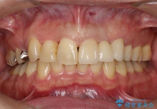 全顎矯正および前歯部ブリッジによる審美治療の症例 治療後