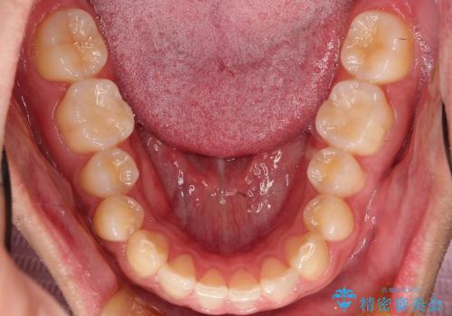 奥歯のセラミック治療(審美)の症例 治療後