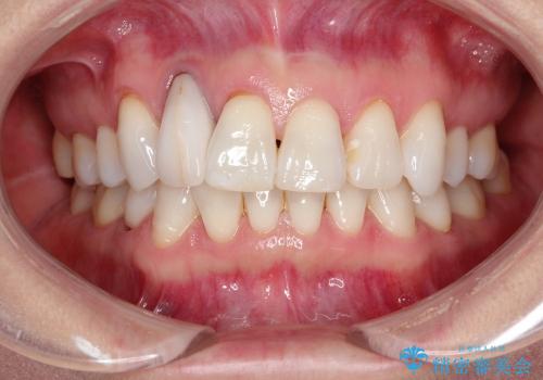 前歯の1歯のセラミッククラウン(オーダーメイドタイプ)の症例 治療前