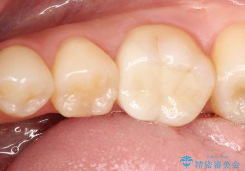 奥歯の虫歯治療→セラミックの治療後