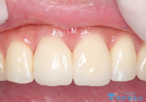 30代女性　前歯の形を治したい　変えたい　歯を大きくしたい　の治療後