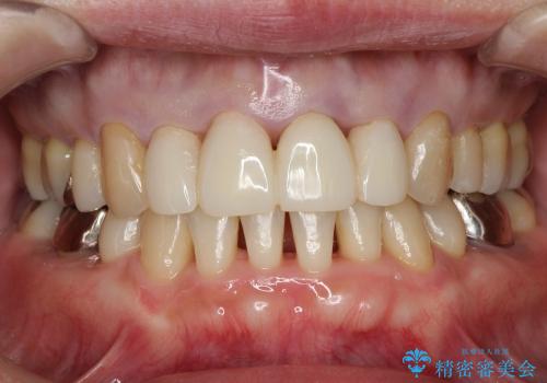 30代女性 前歯の被せものの再修復の治療中