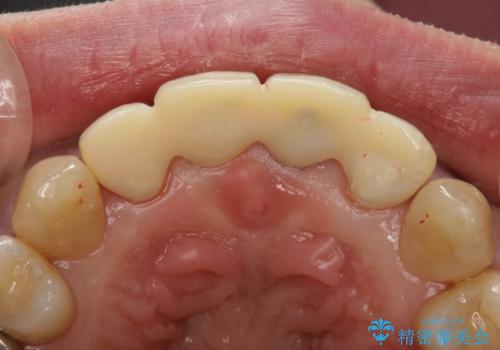 30代女性 前歯の被せものの再修復の治療中