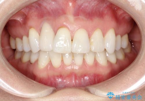 前歯の1歯のセラミッククラウン(オーダーメイドタイプ)の治療後