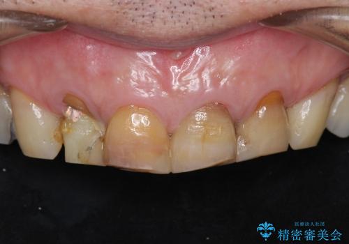 変色した歯のオールセラミッククラウン治療の症例 治療前
