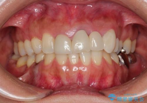 総合歯科診療(矯正歯科治療と審美補綴治療)の症例 治療前