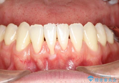矯正治療後に下がってしまった歯ぐきの再生治療の症例 治療前